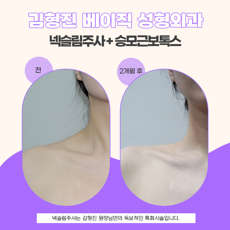 솔직한 넥슬림주사후기 목부터 어깨 라인까지 확 달라졌어요! 관련 이미지 5