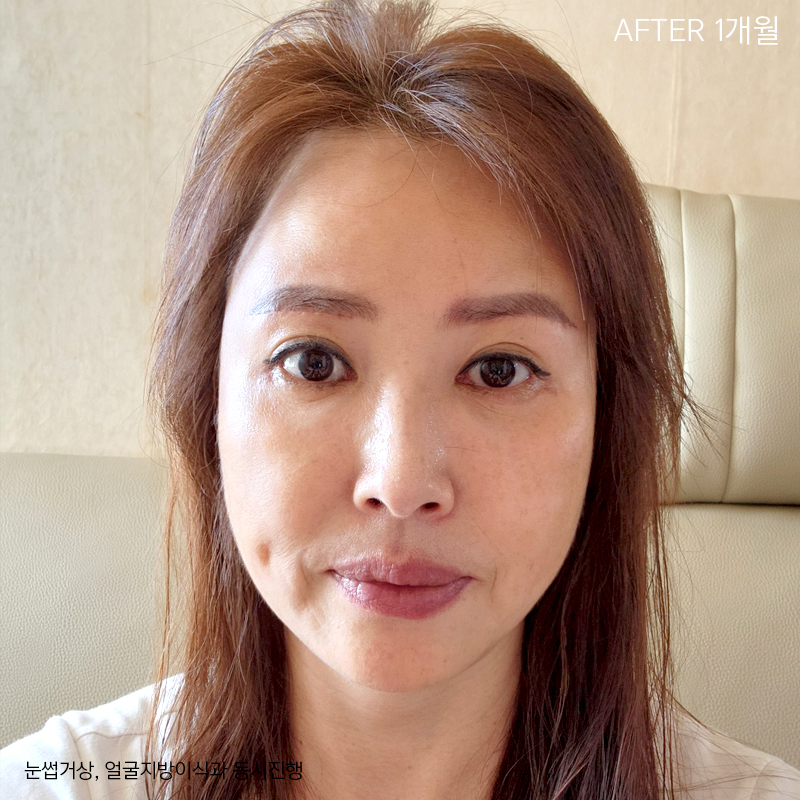 중년눈밑성형 부담없는이유 바로 여기에! 관련 이미지 5