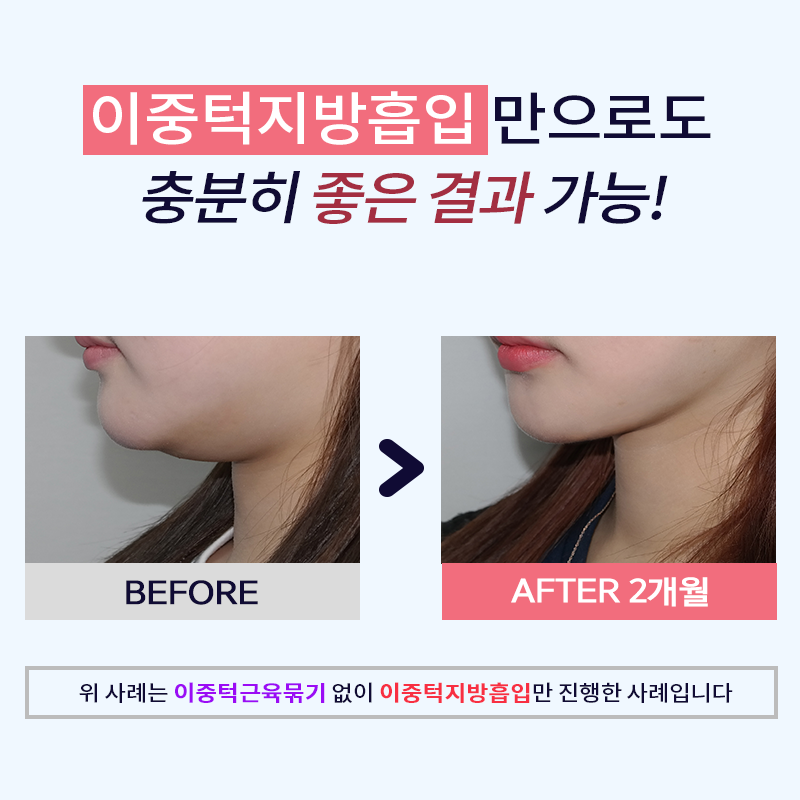 이중턱지방흡입처짐 걱정되셨다면? 관련 이미지 4