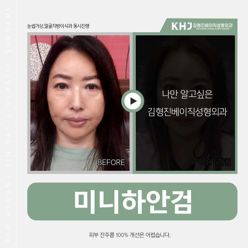 미니하안검효과 궁금하시다구요? 관련 이미지 2