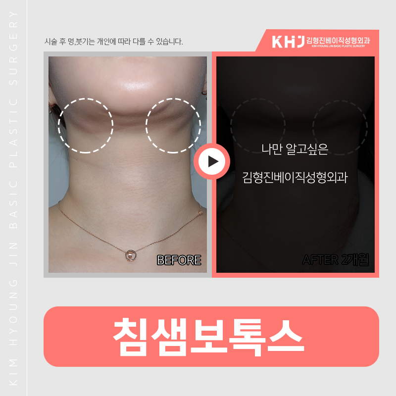 침샘비대증치료방법 간단해요! 관련 이미지 3