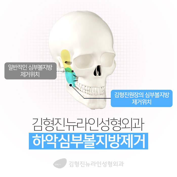 남자심부볼 깔끔하게 정리해요 관련 이미지 5