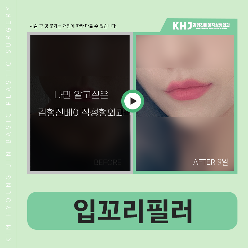 입꼬리비대칭 쉽게 개선하는 방법! 관련 이미지 6