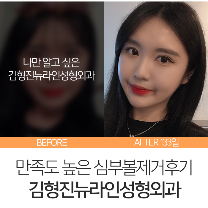 심부볼제거후기 내 맘에 아주 쏙 들어 관련 이미지 7