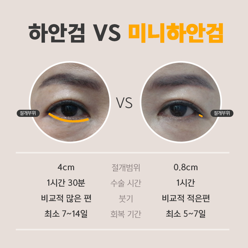 At a Clinic That Performs Even Mini Lower Blepharoplasty Incisions With Precision image 5