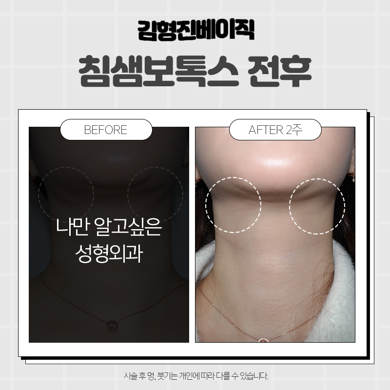 압구정침샘보톡스 맛집 찾아버렸습니다ㅠㅠ 관련 이미지 6