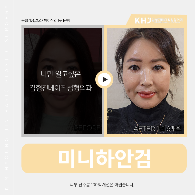 중년눈밑처짐 수술방법 알려드려요! 관련 이미지 5