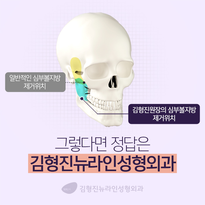 하악심부볼지방제거 볼패임을 잡다 관련 이미지 3