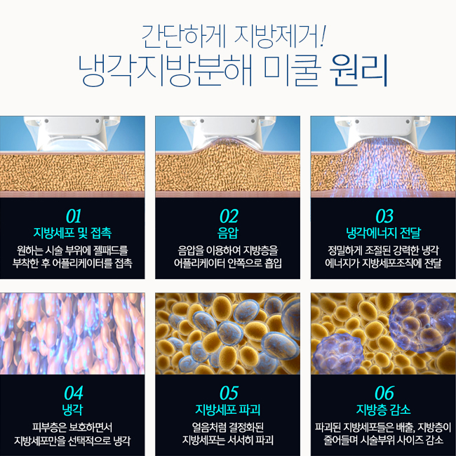 미쿨레이저가격, 미쿨처럼 시원하게! 관련 이미지 2