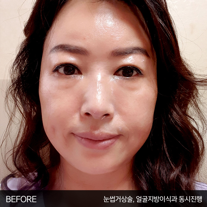 중년눈밑처짐 해결방법은 관련 이미지 2