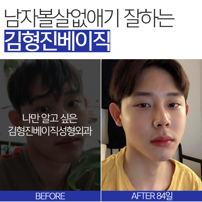 남자볼살없애기 실패한 이유, 아직 몰라요? 관련 이미지 7