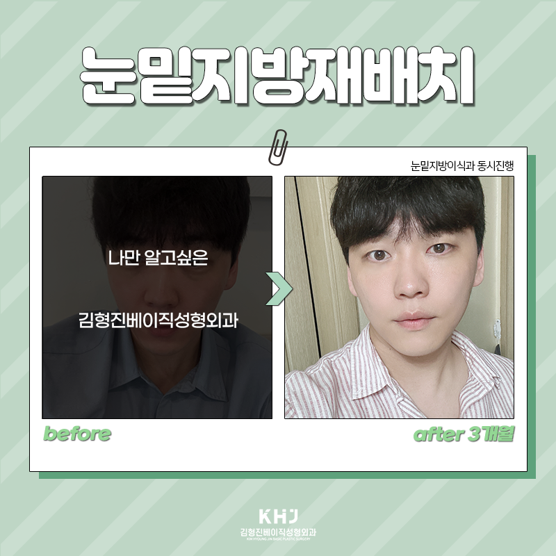 눈밑지방재배치전후 보고 가세요! 관련 이미지 4