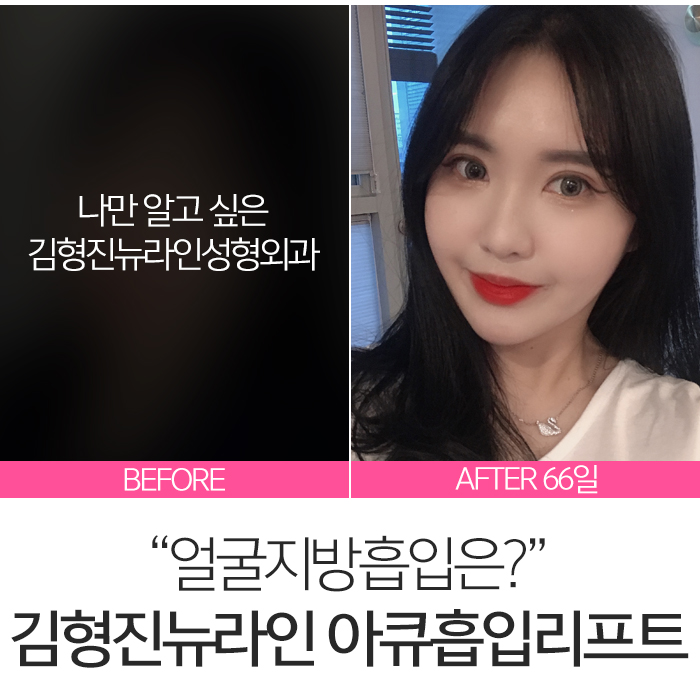 얼굴아큐스컬프 살빼는데 최고죠 관련 이미지 7