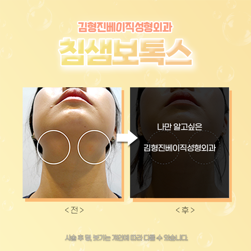 침샘비대증치료 김형진베이직에서 하셔야죠! 관련 이미지 3