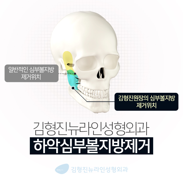 얼굴불독살 없애는방법 따로 있지 관련 이미지 4
