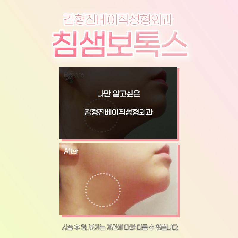 침샘보톡스효과 볼 수 있는 곳에서 하셔야죠 관련 이미지 4