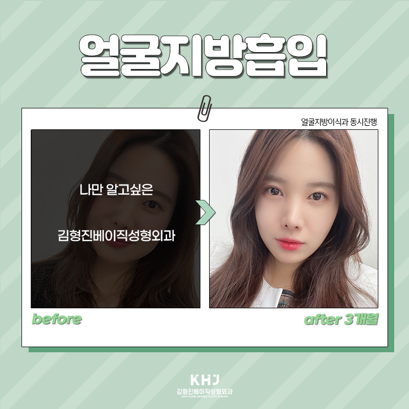 얼굴지흡효과 김형진베이직에서 알려드려요! 관련 이미지 6