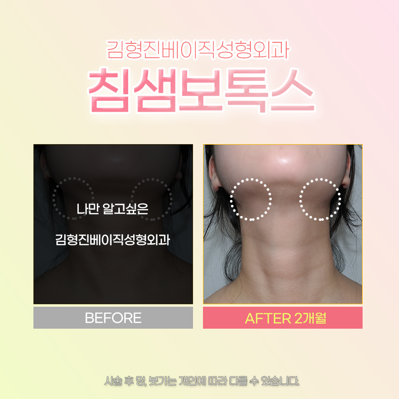 침샘보톡스주기 확인하고 시술 받아야 하는 이유 관련 이미지 4
