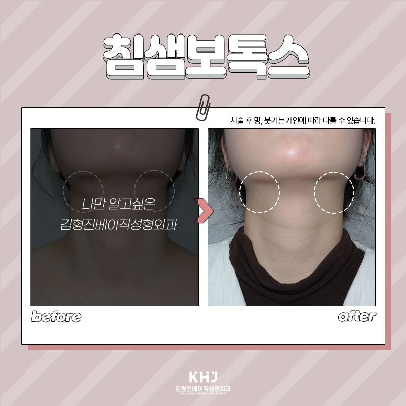 침샘보톡스유지기간 궁금하셨죠? 관련 이미지 6