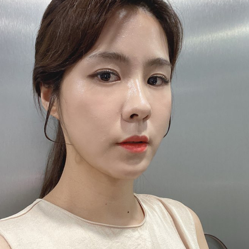 눈밑지방재배치수술 미루지 말고 이젠 해야할 때! 관련 이미지 5