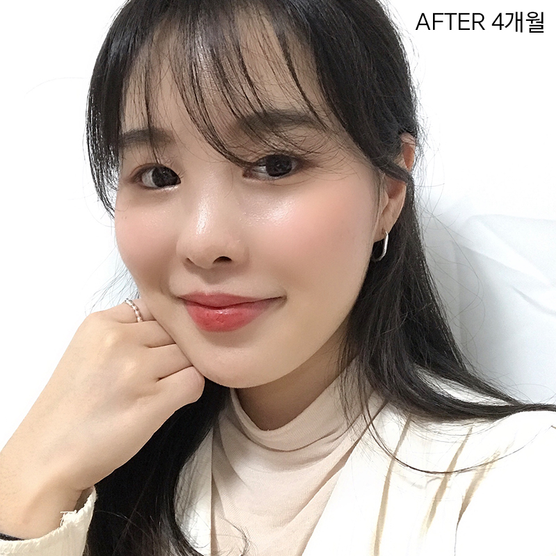 심부볼제거술, 확실한 볼살제거 방법 관련 이미지 7