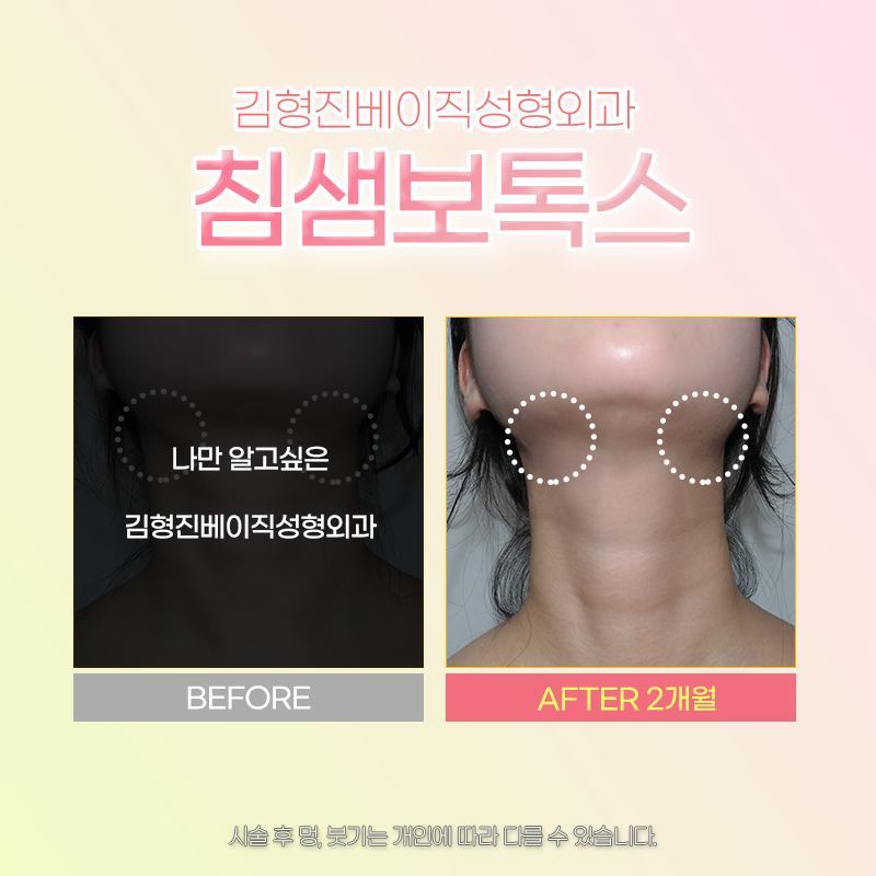 침샘보톡스시술 잘하는데서 해야 하는 이유? 관련 이미지 6