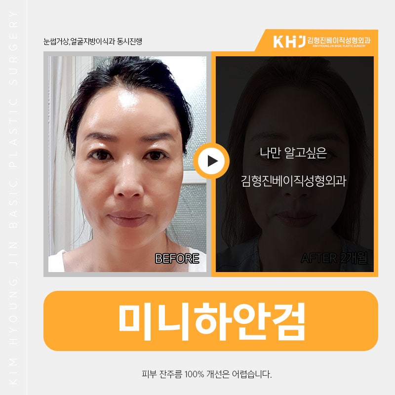 미니하안검재수술 발생 확률 적은 김형진베이직 관련 이미지 4