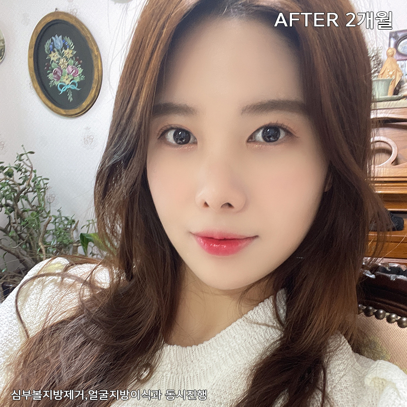 얼굴살제거 방법? 바로 알려드릴게요! 관련 이미지 6