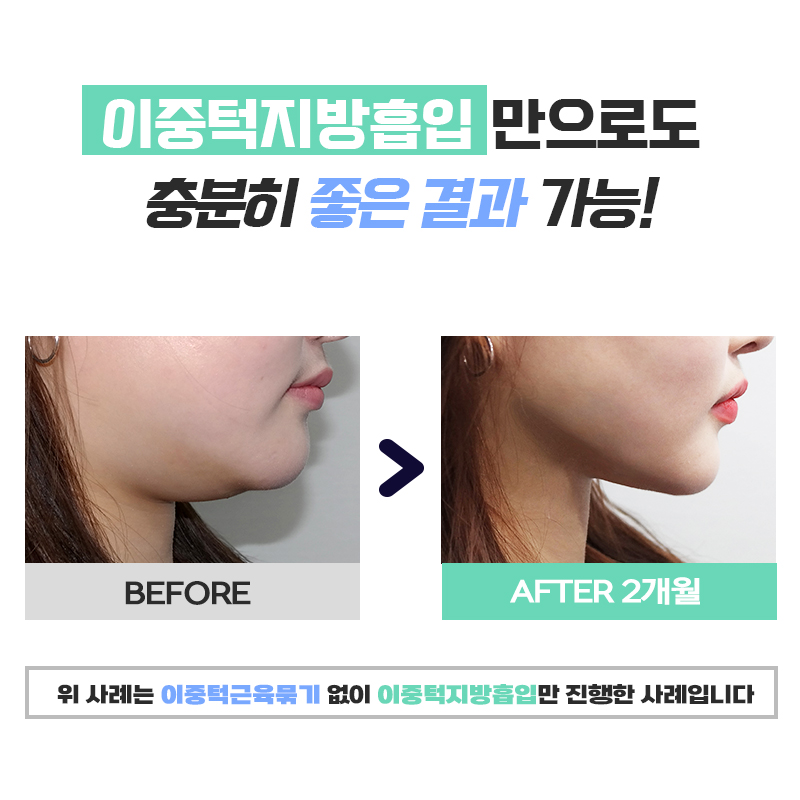 이중턱살제거 김형진베이직에서 한번에 해결했어요 관련 이미지 6