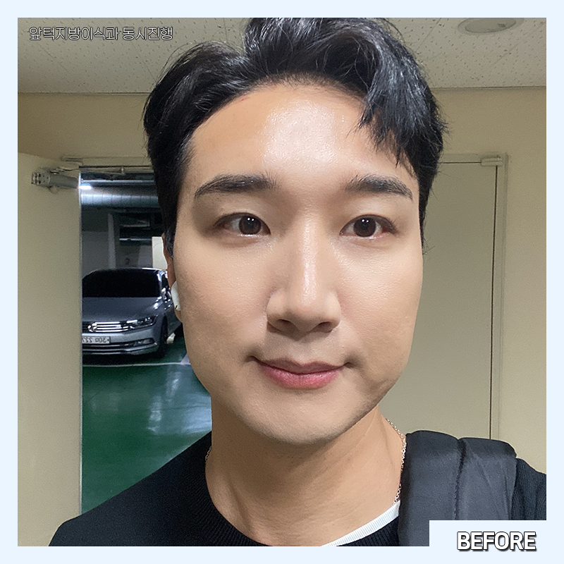 남자심부볼제거 가능하냐구요? 당연하죠! 관련 이미지 2