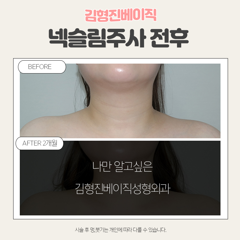 웨딩시술은 김형진베이직에서! 관련 이미지 4