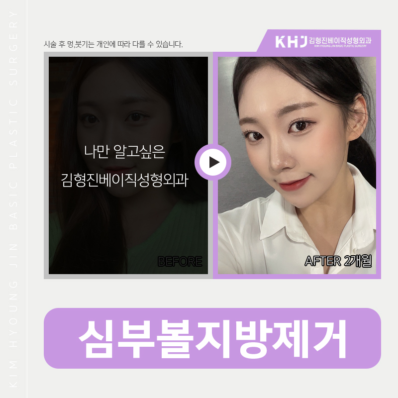 심부볼인모드로 가능할까요? 관련 이미지 4
