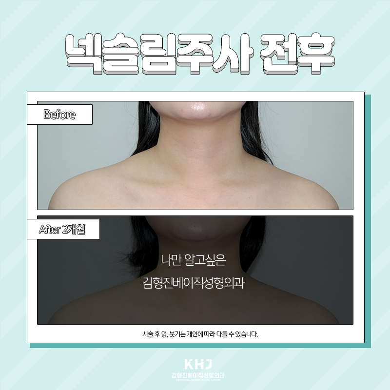 웨딩시술 뭐해야 할지 고민되셨다면? 관련 이미지 4