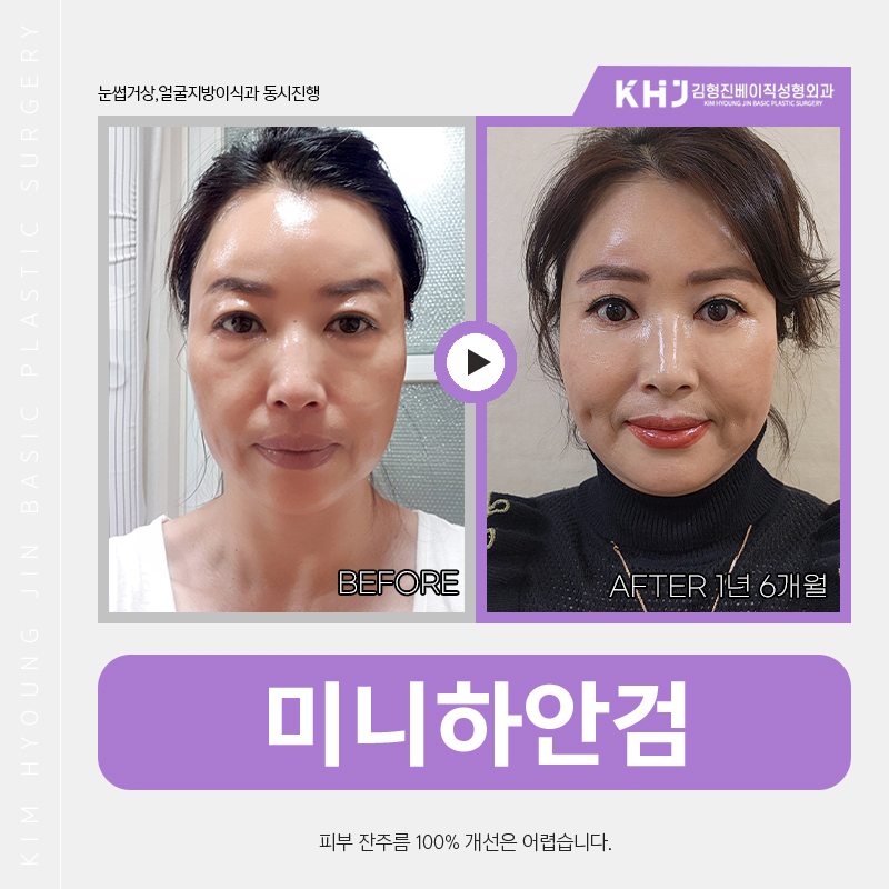 중년눈밑처짐수술 미니하안검으로 동안 인상 완성했어요! 관련 이미지 5