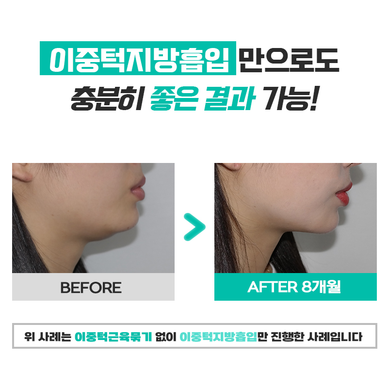 이제는 소프트하게! 얼굴지방흡입수술로 완성하는 부드러운 브이라인 관련 이미지 6