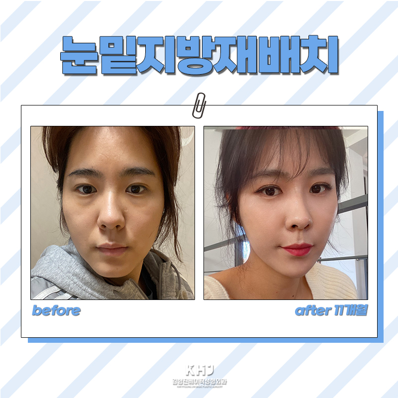 빠르게 눈밑지방없애는방법으로 선택한 눈밑지방재배치, 후회 없어요 관련 이미지 5