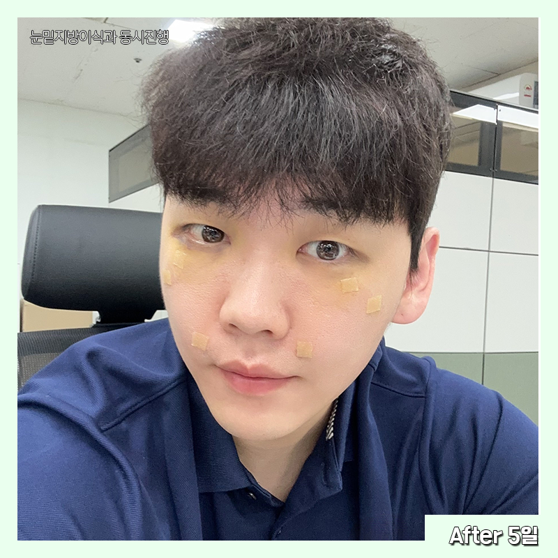 눈밑지방재배치유지력 오래가는 곳 찾으셨다면 관련 이미지 4