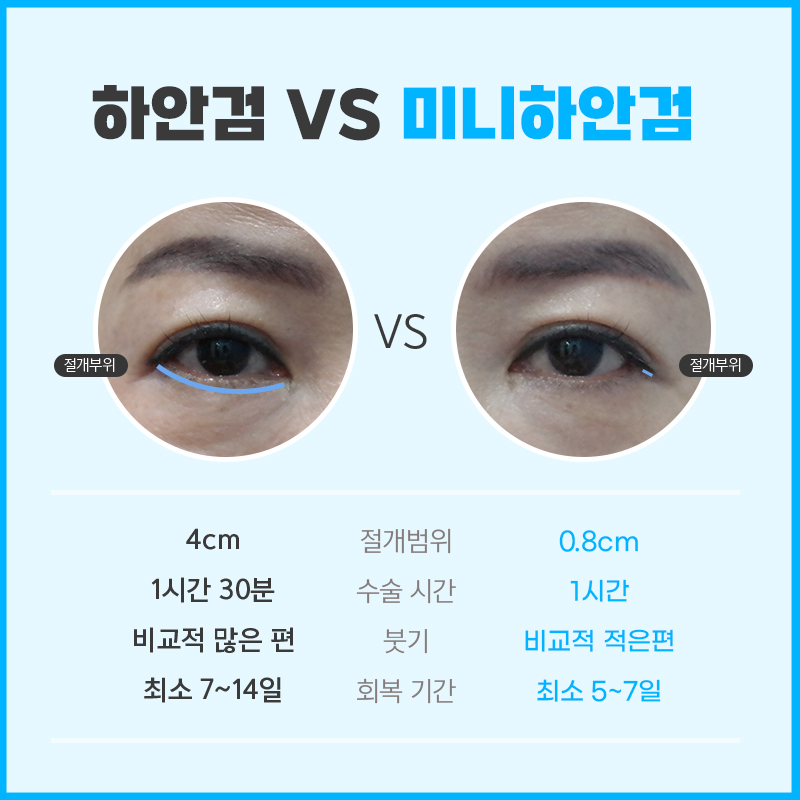 중년눈밑처짐 해결법은 단 한 가지 관련 이미지 5