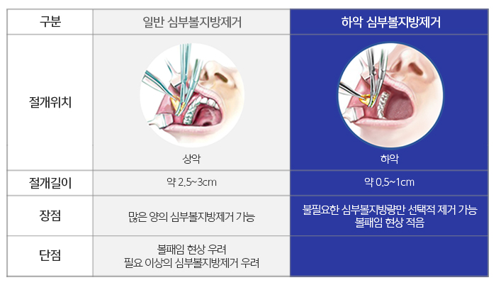 심부볼제거후기 좋을 수 밖에 없는 관련 이미지 5