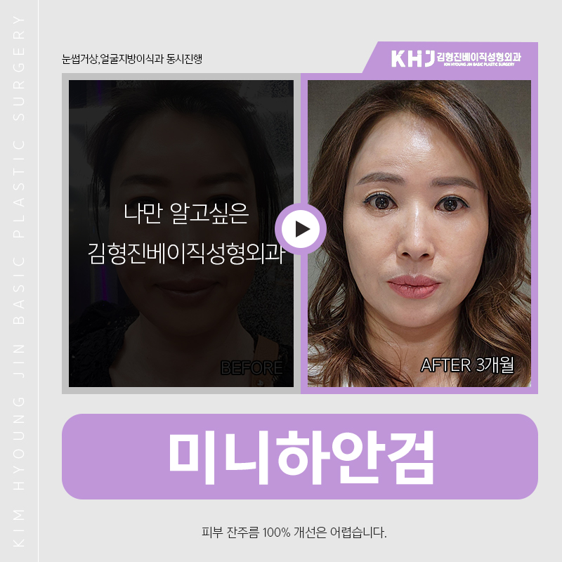 미니하안검회복기간 어느정도냐구요? 관련 이미지 4