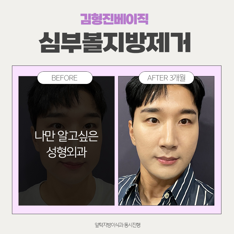 Cheek Fat Removal Review — I Didn’t Expect Such a Big Difference... image 6