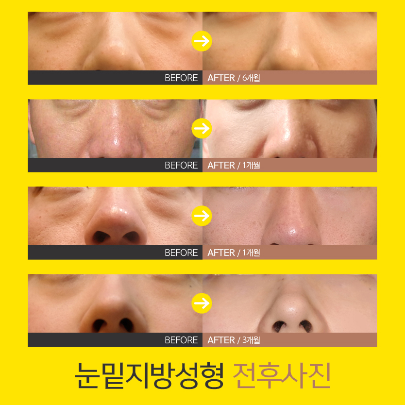 눈밑지수술 효과 대박이에요ㅠㅠ 관련 이미지 6