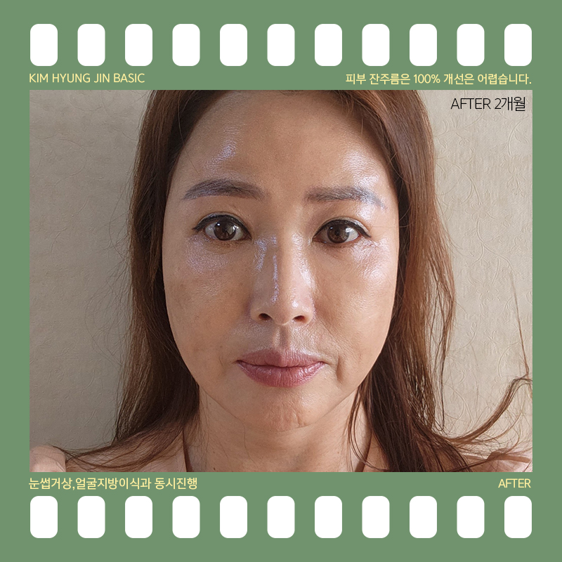 미니하안검절개 너무 깔끔해 관련 이미지 8