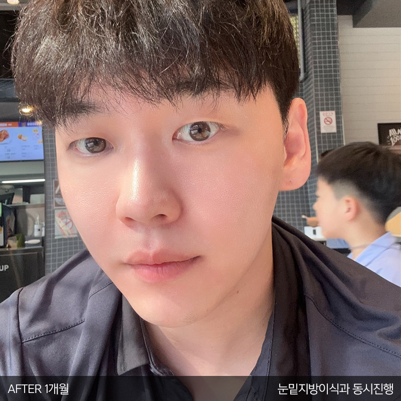 눈밑지방재배치수술효과 모르시는분! 관련 이미지 4