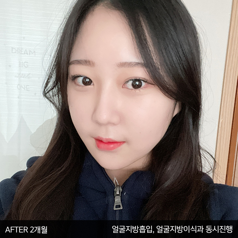 눈밑수술! 어떤건지 궁금하시죠? 관련 이미지 6