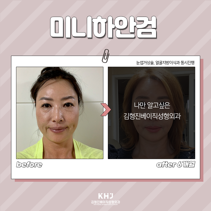 미니하안검효과 이렇게나 다양해! 관련 이미지 4