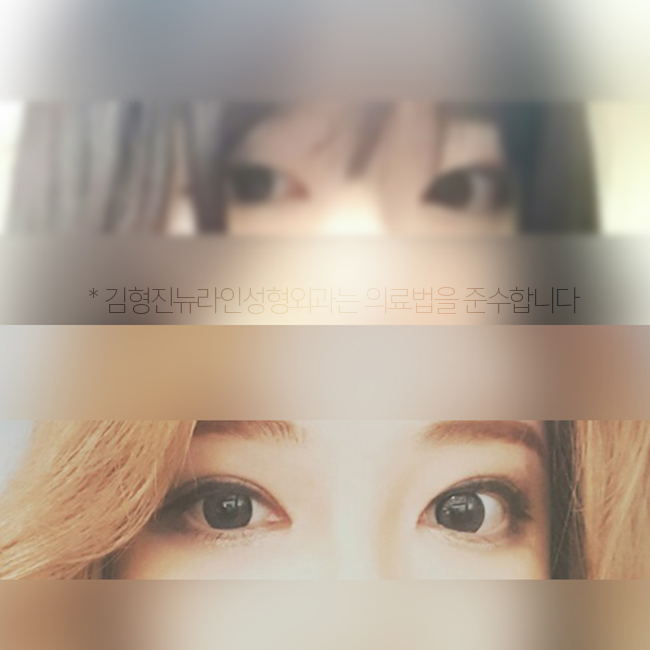 학생 쌍수 후기 리얼로 보니 하고 싶잖아~ 관련 이미지 4