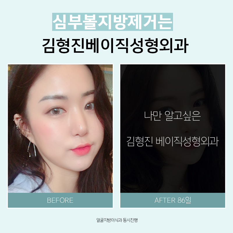 왜 하악심부볼이냐면요. 관련 이미지 4