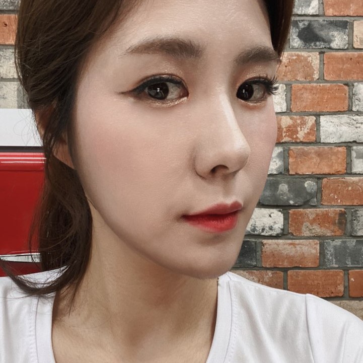 눈밑지방재배치효과 보고 눈밑 환하게 밝혔어요 관련 이미지 2