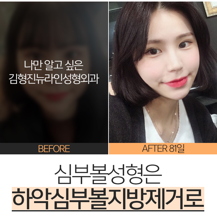 심부볼성형 능력자 김형진원장님! 관련 이미지 5